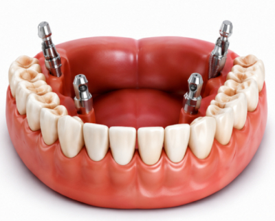Full Mouth Dental Implants
