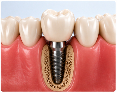 Dental Implant Crown