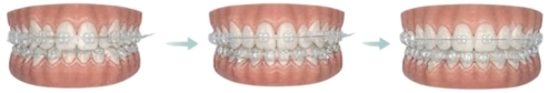 Bite alignment with Invisalign