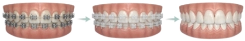 Closing gaps with Invisalign