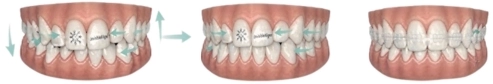 Straighter teeth with Invisalign