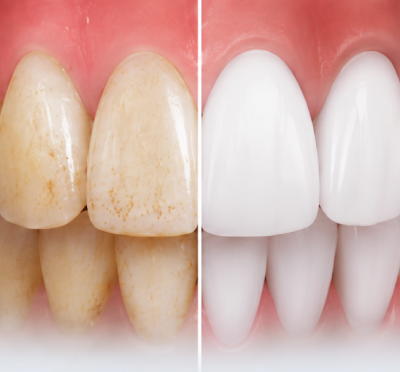 Remove Teeth Stains with Professional Whitening