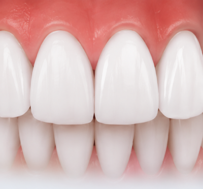 Beautiful White Smile After Laser Teeth Whitening